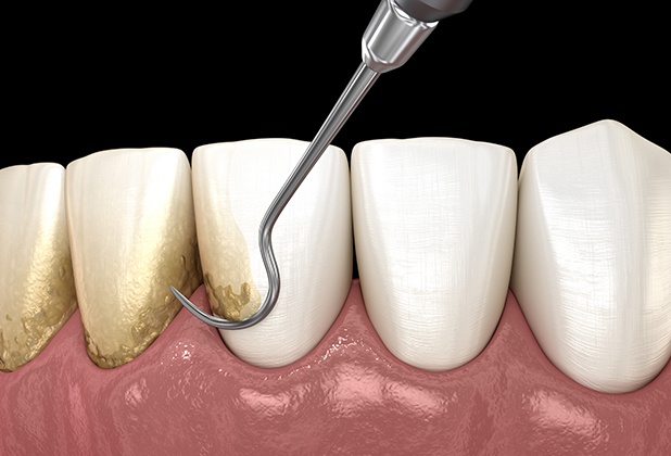 Animated scaling and root planing periodontal therapy