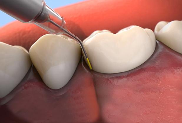 Animated Arestin antibiotic therapy process