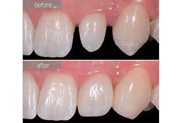 Woman's smile compared with porcelain veneer shade chart