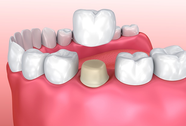 Animated dental crown placement