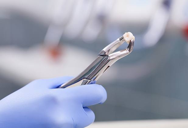 Metal clasp holding extracted tooth