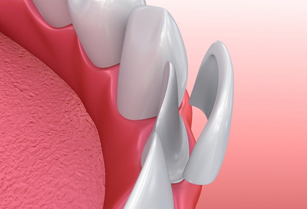 A digital image showing a veneer being placed over the surface of a tooth