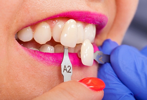 A cosmetic dentist in Beverly Hills using a shade guide to determine the color of a patient’s veneers