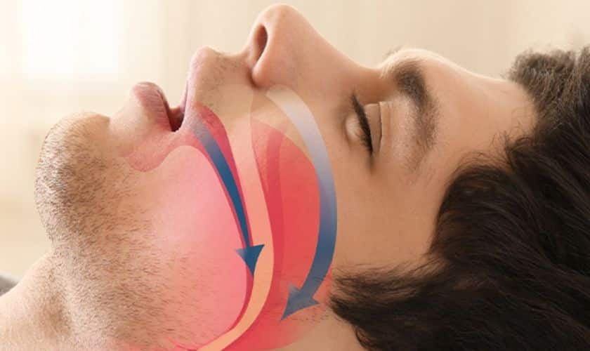 A Better Guide To Understanding Sleep Apnea Therapies