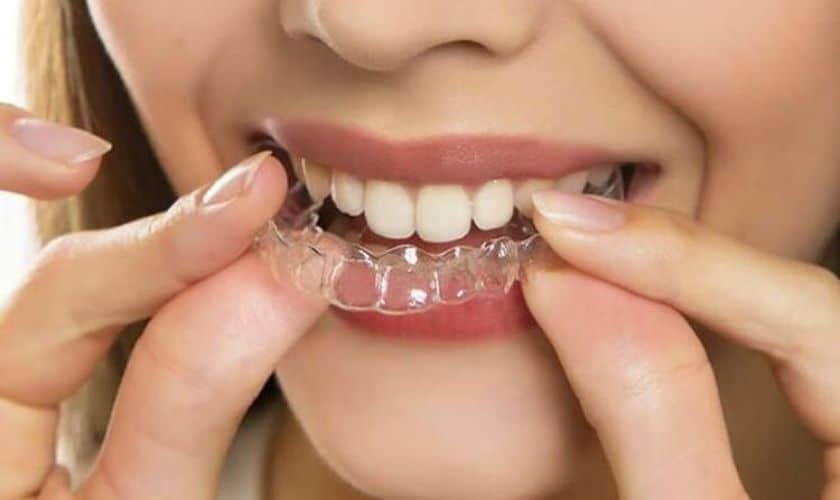 Invisible Aligners, Visible Results: Navigating Invisalign Treatment in Beverly Hills