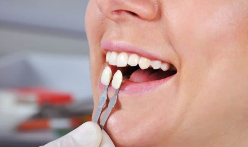 Achieve A Perfect Smile with Veneers