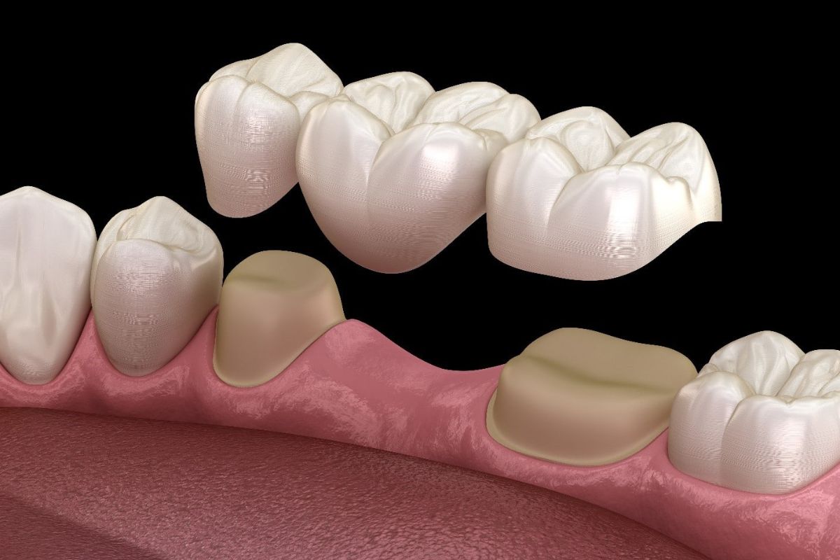 Are Dental Bridges The Best Option For Missing Teeth?