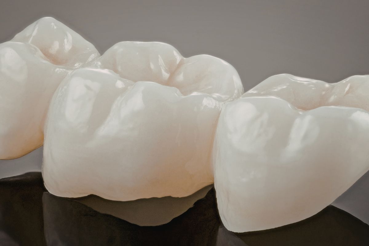 Dental Bridge vs Dental Implant: Which Is Better?
