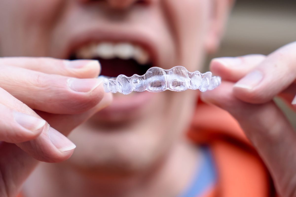Is Invisalign a Good Option for Fixing an Overbite?