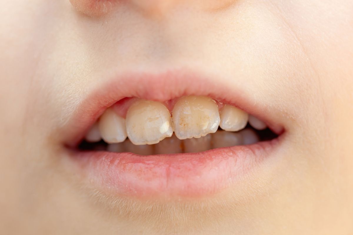 White Patches on Teeth: When to Worry and How to Fix Them